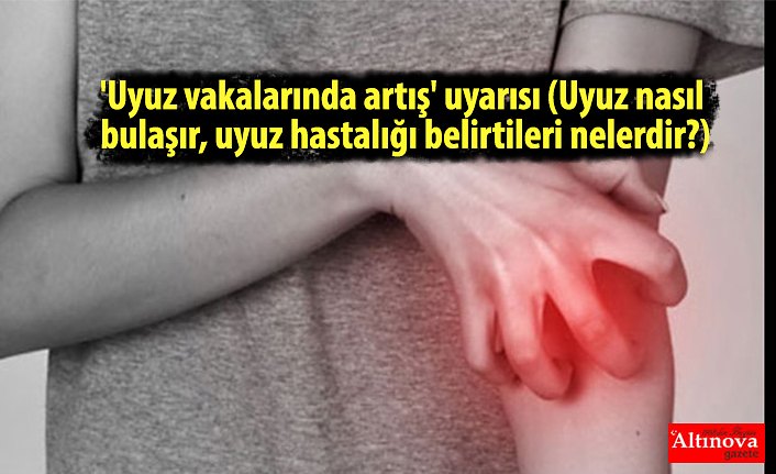 'Uyuz vakalarında artış' uyarısı (Uyuz nasıl bulaşır, uyuz hastalığı belirtileri nelerdir?)