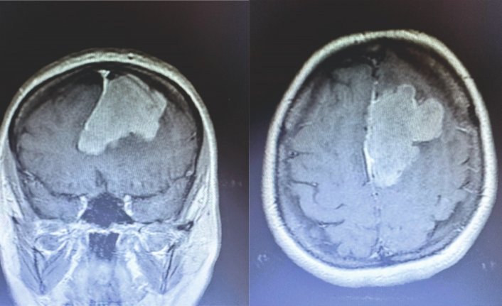 Erbaa'da beyin tümörü ameliyatı yapıldı